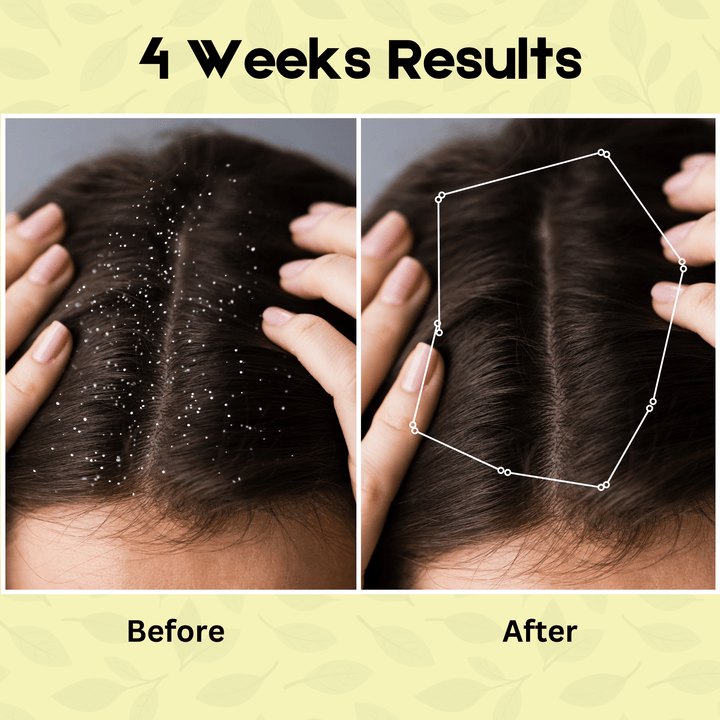 Dandruff Defense Hair Oil | 100 ML - Alif Naturals
