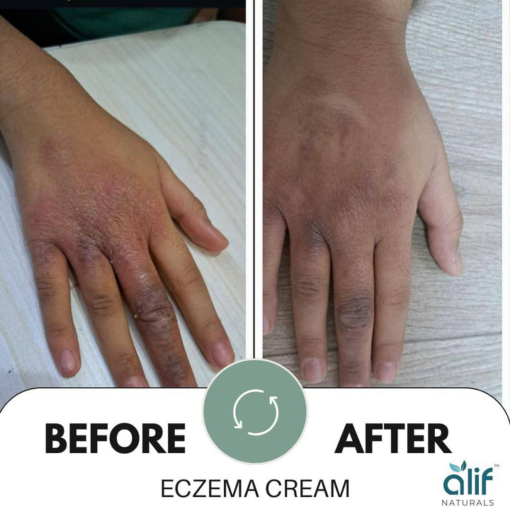 Eczema Cream | 200 ML - Alif Naturals